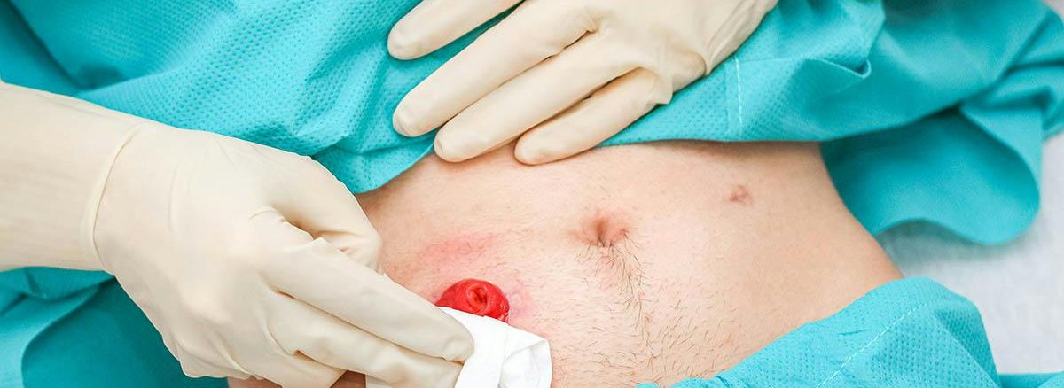 Gallstone removal discount